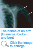 The bones of an arm (Humerus) broken and bent