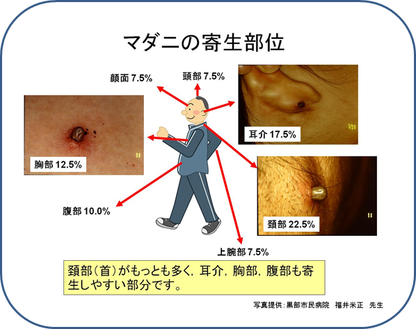 ダニの寄生部位図